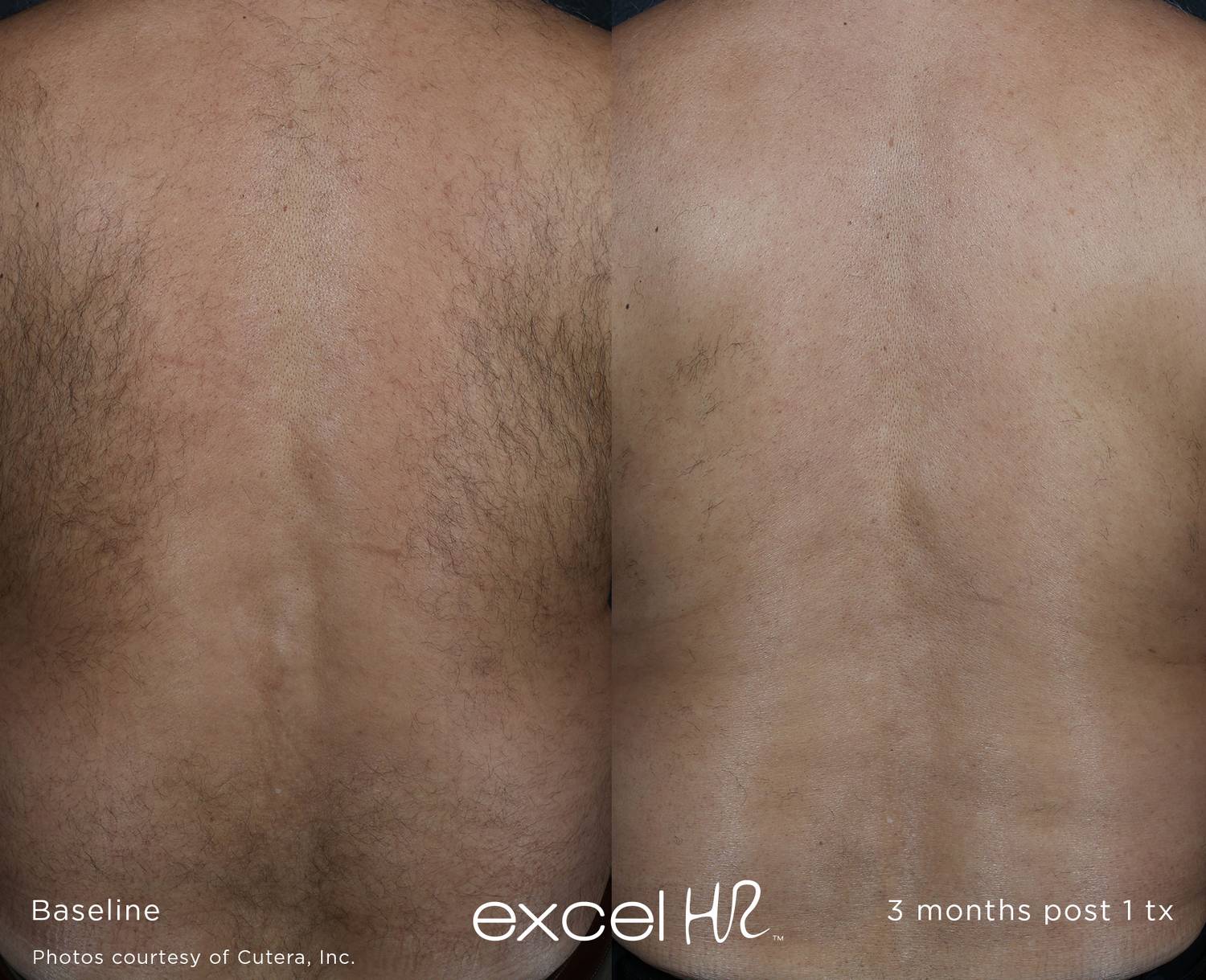 Laser Hair Removal Before and After Back